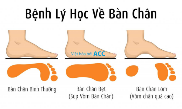 7 câu hỏi thường gặp về hội chứng bàn chân bẹt | ACC